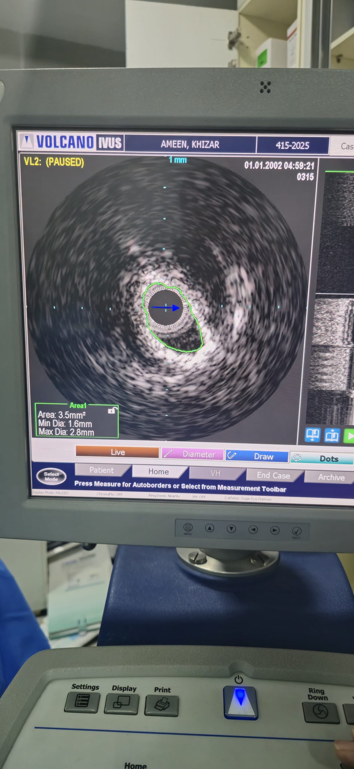 Vascular Calcification